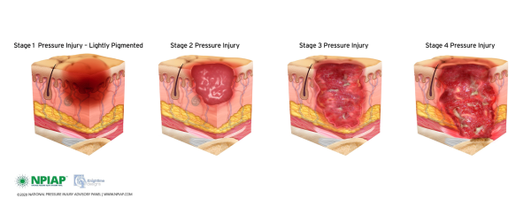 Pressure Ulcer Prevention And Management - Medstrom